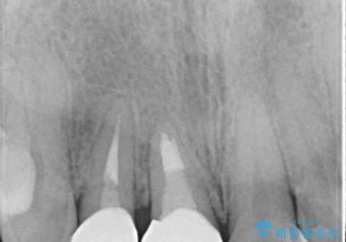前歯のクロスバイトと治療が必要なむし歯　矯正とセラミックの総合歯科治療の治療後