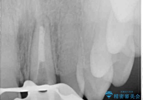 [ 前歯セラミック治療 ]白く不自然な前歯をきれいにしたいの治療中