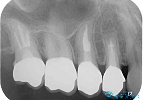 臼歯部メタルフリー再補綴の治療後