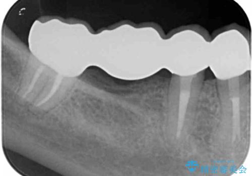 臼歯部メタルフリー再補綴の治療後