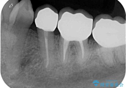 歯ぐきの腫れを改善する歯周外科手術を伴うセラミック治療の治療後