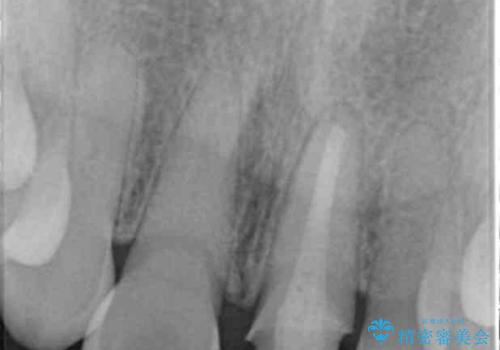 [ 前歯セラミック治療 ]白く不自然な前歯をきれいにしたいの治療中