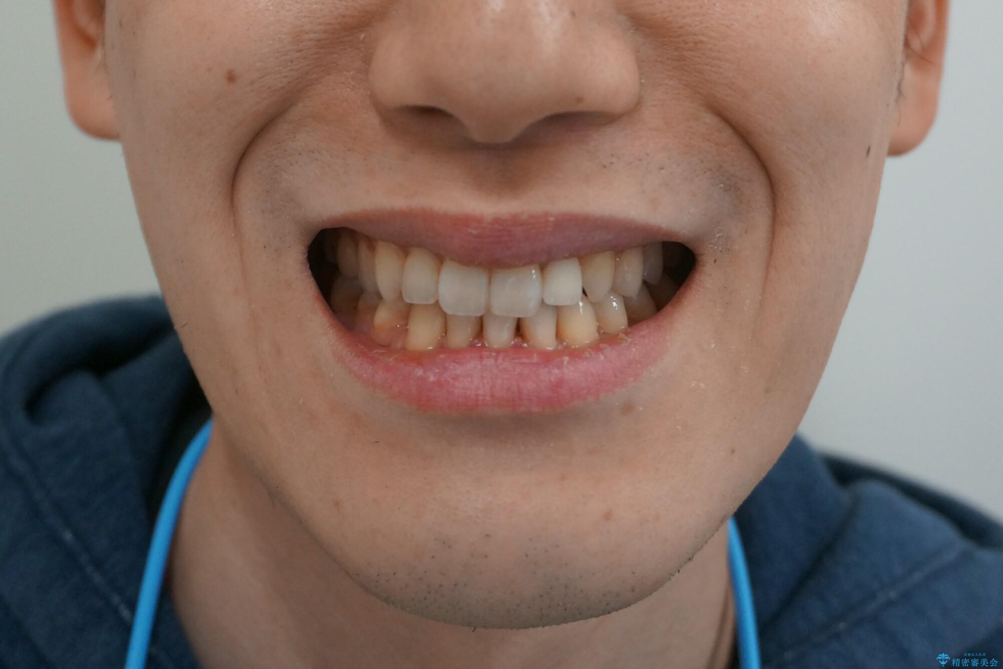 前歯の矮小歯　奥歯の反対咬合　をインビザラインでの治療後（顔貌）