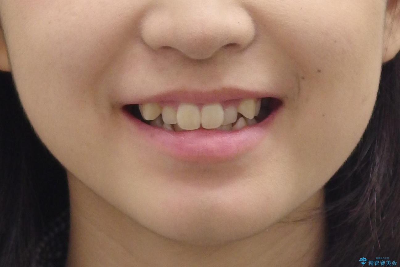 八重歯・前歯のがたつき　抜かない矯正　インビザラインでの治療前（顔貌）