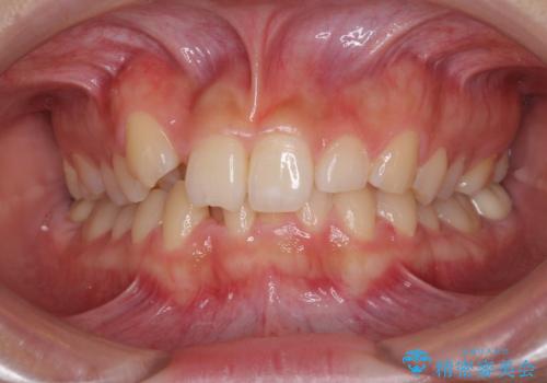 気になる八重歯を改善　補助装置併用のインビザライン治療の症例 治療前