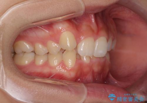 気になる八重歯を改善　補助装置併用のインビザライン治療の治療前
