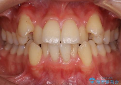 八重歯がスッキリ　抜歯ワイヤー矯正の症例 治療前