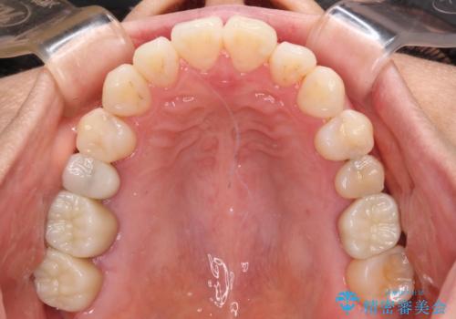 気になる前歯をインビザライン・ライトで　矯正治療後には銀歯をセラミックにの治療後