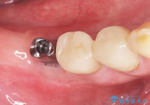 奥歯のインプラント　70代男性の治療後
