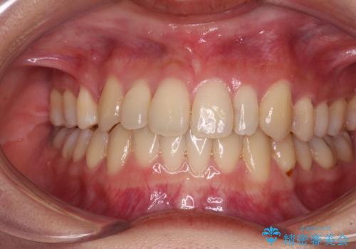八重歯の抜歯矯正　補助装置を用いたインビザライン矯正の症例 治療後
