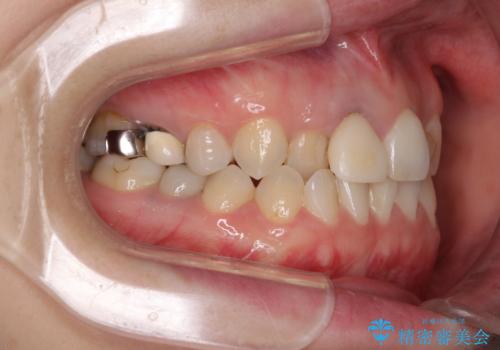 前歯のクロスバイトと治療が必要なむし歯　矯正とセラミックの総合歯科治療の治療前