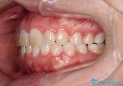 気になる前歯を治したい　インビザラインで気づかれずに矯正治療の治療後