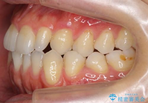 前歯の矮小歯　奥歯の反対咬合　をインビザラインでの症例 治療前