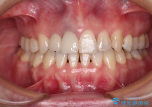 前歯のクロスバイトと治療が必要なむし歯　矯正とセラミックの総合歯科治療の症例 治療後