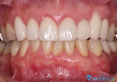 歯磨きの度にしみる歯　露出した歯根を歯肉移植で改善の治療後