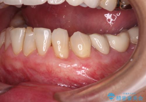 歯磨きの度にしみる歯　露出した歯根を歯肉移植で改善の症例 治療後