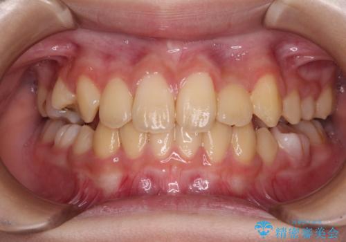 過剰歯を抜歯して前歯を排列　インビザライン・ファーストによる小学生のⅠ期治療の症例 治療後