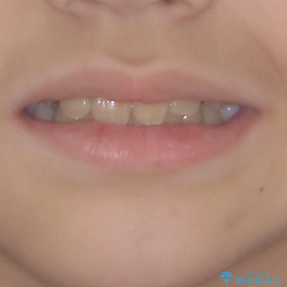 過剰歯を抜歯して前歯を排列　インビザライン・ファーストによる小学生のⅠ期治療の治療後（顔貌）