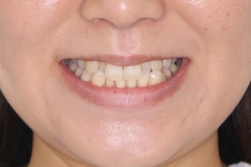 【インビザライン】前歯の凸凹をなおしたいの治療前（顔貌）