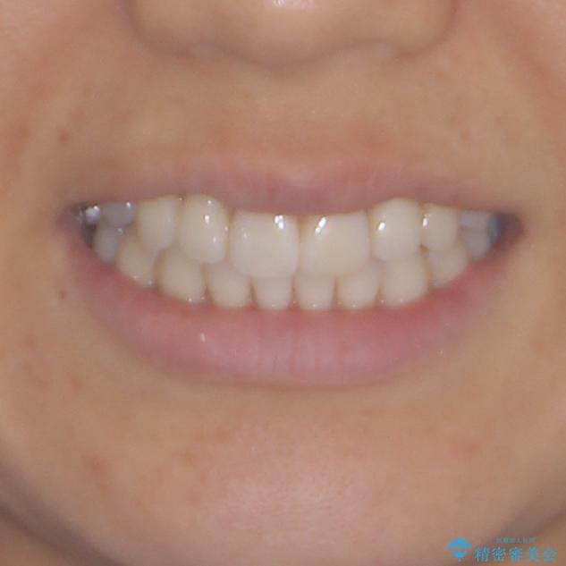 気になる前歯をインビザライン・ライトで　矯正治療後には銀歯をセラミックにの治療後（顔貌）