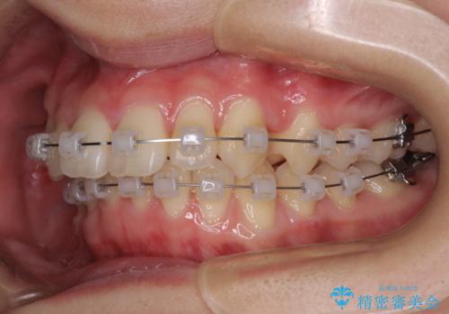 【モニター】犬歯のクロスバイトを目立たないワイヤー装置での治療中