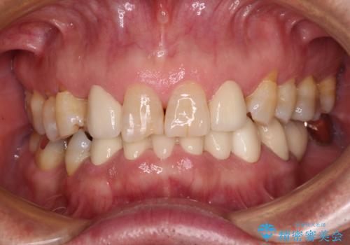 乳歯や矮小歯の多い前歯　部分矯正と補綴治療による審美歯科治療の症例 治療後
