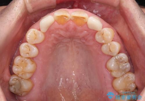 乳歯や矮小歯の多い前歯　部分矯正と補綴治療による審美歯科治療の治療後