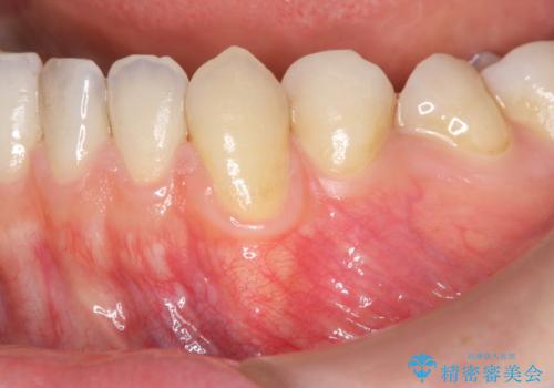 歯茎の下がりが気になる　歯肉移植でさがりにくくするの治療前