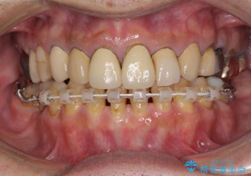 下顎の部分矯正を行ってから奥歯の補綴治療とインプラント治療の治療中