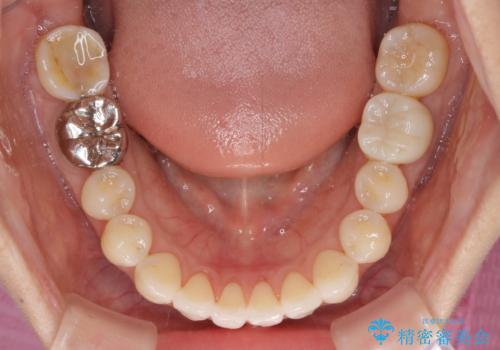 気になる前歯をインビザライン・ライトで　矯正治療後には銀歯をセラミックにの治療中