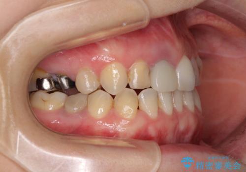 前歯のクロスバイトと治療が必要なむし歯　矯正とセラミックの総合歯科治療の治療中