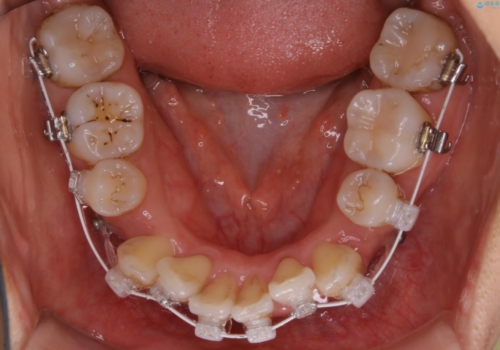 八重歯がスッキリ　抜歯ワイヤー矯正の治療中