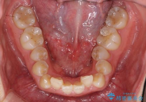 八重歯・前歯のがたつき　抜かない矯正　インビザラインでの治療前