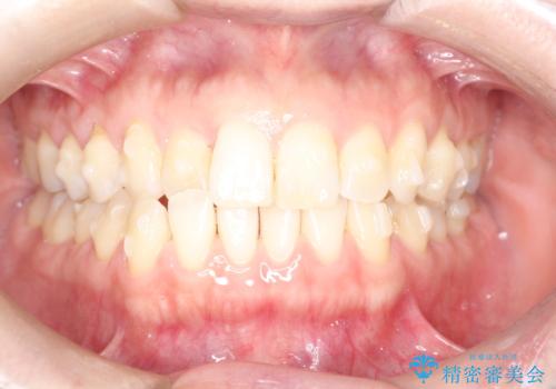 上の歯と下の歯が反対にかんでいる　インビザラインによる目立たない矯正の治療中
