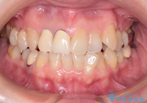 【長いポストの歯】再根管治療からオールセラミッククラウンの症例 治療前