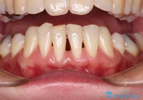 下顎前歯の歯肉退縮　歯肉移植による根面被覆の治療前