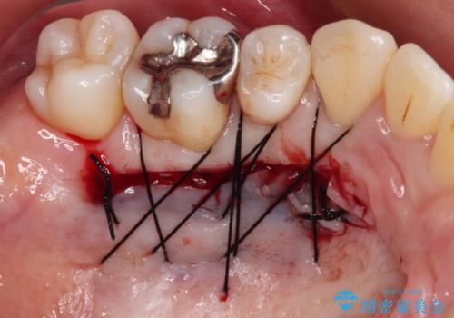下顎前歯の歯肉退縮　歯肉移植による根面被覆の治療後