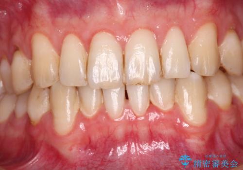 しみてしまう下顎の犬歯　歯肉移植による根面被覆の治療前