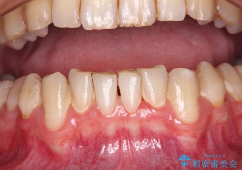 しみてしまう下顎の犬歯　歯肉移植による根面被覆の症例 治療前