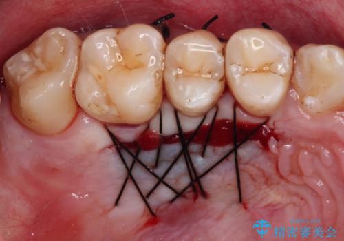しみてしまう下顎の犬歯　歯肉移植による根面被覆の治療後