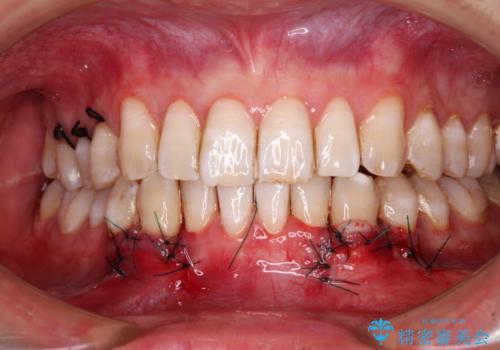 しみてしまう下顎の犬歯　歯肉移植による根面被覆の治療中