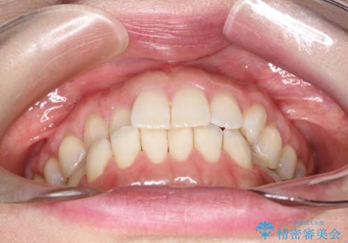 上の歯と下の歯が反対にかんでいる　インビザラインによる目立たない矯正の治療前
