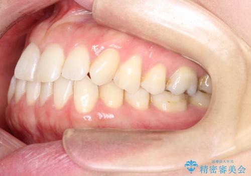 上の歯と下の歯が反対にかんでいる　インビザラインによる目立たない矯正の治療前