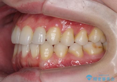前歯の矮小歯　奥歯の反対咬合　をインビザラインでの症例 治療後