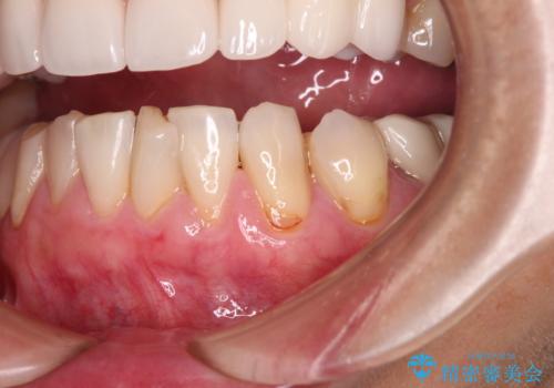 歯磨きの度にしみる歯　露出した歯根を歯肉移植で改善の症例 治療前
