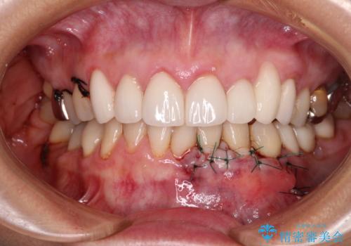 歯磨きの度にしみる歯　露出した歯根を歯肉移植で改善の治療中