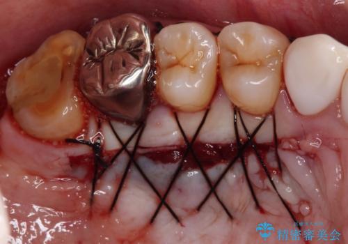歯磨きの度にしみる歯　露出した歯根を歯肉移植で改善の治療前
