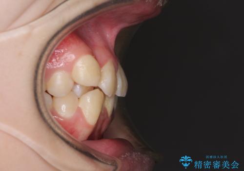 八重歯で正中が右にずれている　ワイヤー装置での抜歯矯正で正中位置を改善の治療前