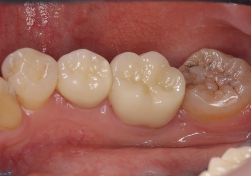 詰め物の下が虫歯　つぎはぎの歯をしっかり治療の治療後