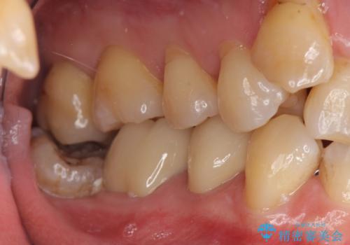 詰め物の下が虫歯　つぎはぎの歯をしっかり治療の治療後